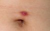 Infected-belly-button-piercing.jpg