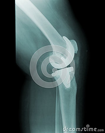 knee-x-ray-joint-replacement-13322446.jpg