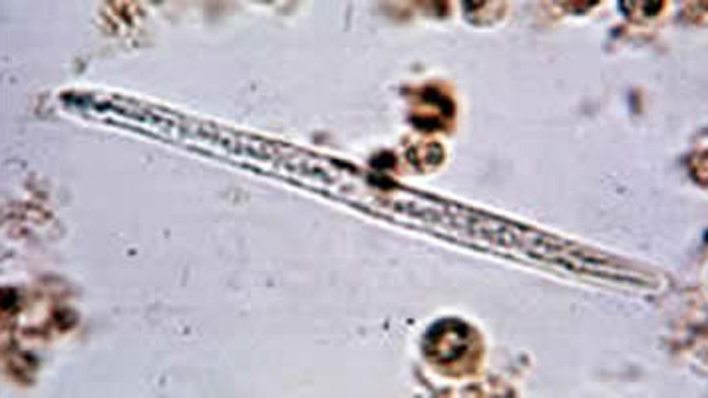 648x364_Trichinosis.jpg