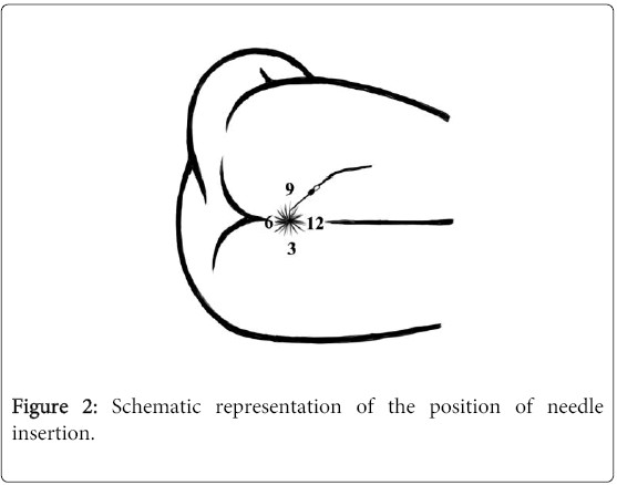 neurology-neurophysiolog-position-needle-5-227-g002.png