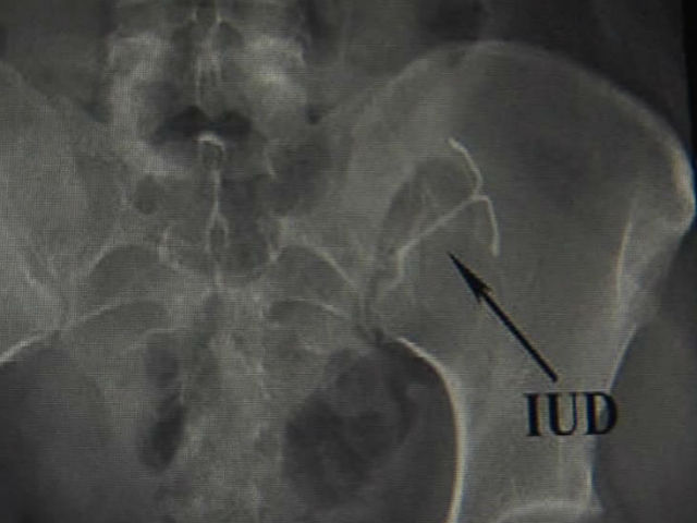 iud_pelvis_1372340497667_435119_ver1.0_640_480.jpg