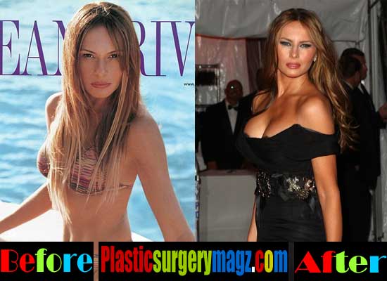 Melania-Trump-Plastic-Surgery-Boob-Job.jpg