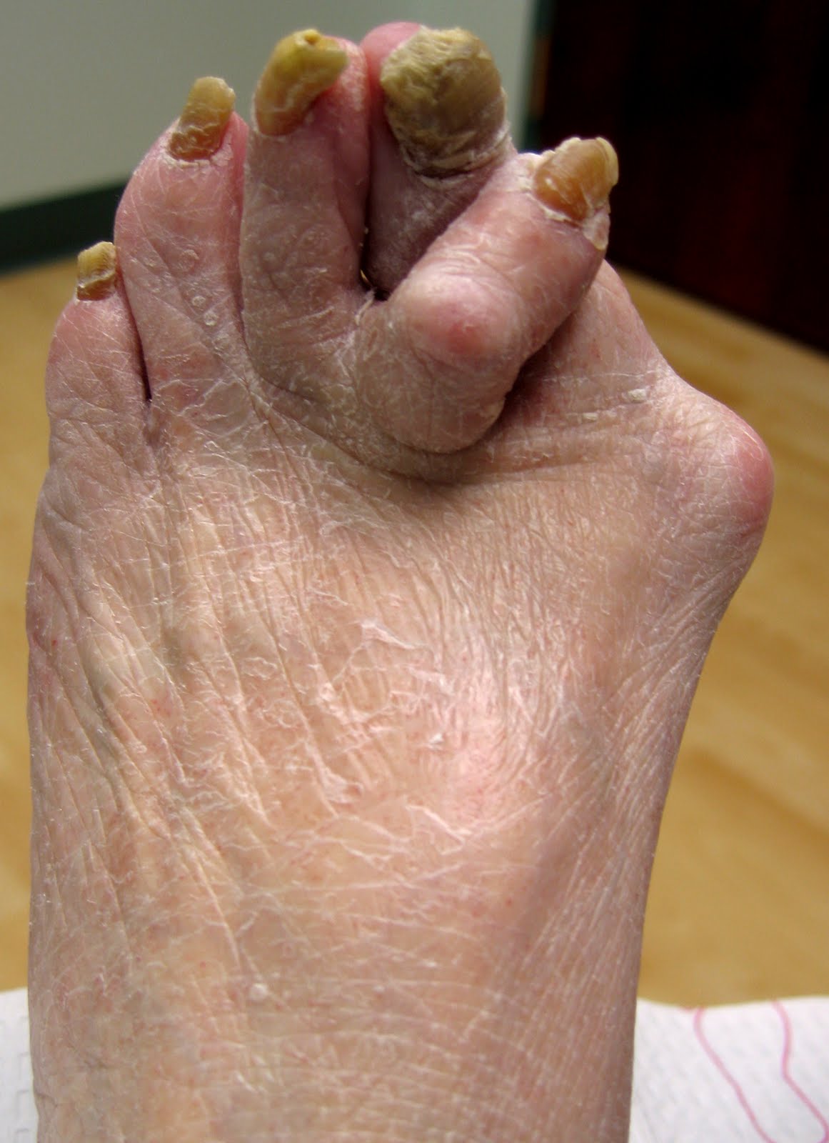 bunion.jpg