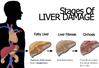 stages-of-liver-damage.jpg