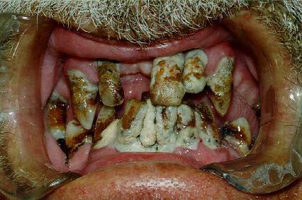 nasty-teeth-3.jpg